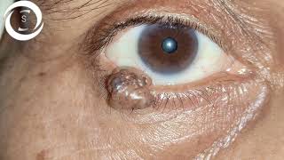 Ophthalmic Signs Eyelids