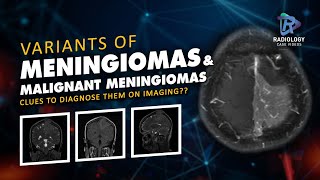 Variants of Meningioma,Malignant Meningioma Clues to diagnose them on imaging #Diffusion Meningiomas