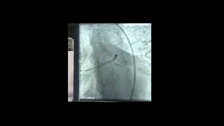 Left main-LAD-LCX bifurcation stenting