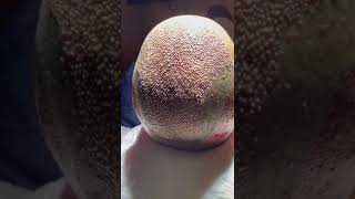 Immediately after hair implantation #hairtransplant #hairgrowth