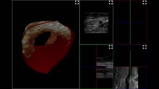 3D US 1 w post-treatment, same patient, post EVLA  & UGFS for accessory vein Capital Vein Links