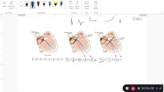 Heart Blocks Rhythm Interpretation