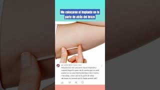 Me colocaron el implante en la parte de atrás del brazo