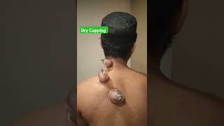 dry Cupping for muscular pain #painreliefcenter #physiotheraphy #painrelief #drycupping