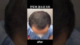 [SMP두피문신] 전두부&정수리 탈모 고민해결