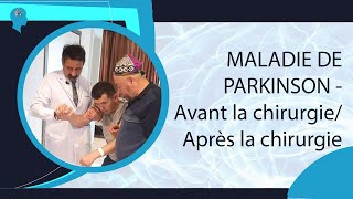 MALADIE DE PARKINSON - Avant la chirurgie/ Après la chirurgie #parkinson #dratillayilmaz