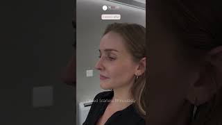 3 weeks after Closed Scarless Rhinoplasty 👃🇨🇭 | Dr. med. Simon Zimmermann