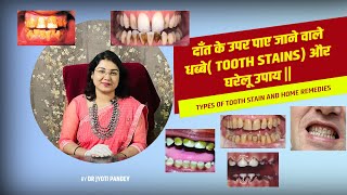 दाँत के उपर पाए जाने वाले धब्बे( tooth stains) और घरेलू उपाय ||