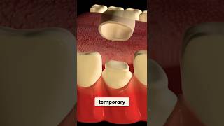 Temporary Crowns are Temporary #dentist