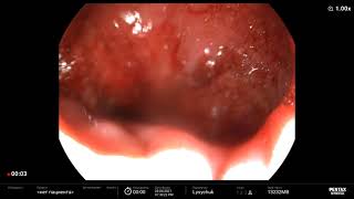 Mallory-Weiss syndrome. Endoscopic Treatment Bleeding. Forrest IB. С-м Мелори-Вейса, гемостаз