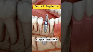 IMPLANT single or Bridge together