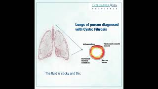 Cystic Fibrosis | Columbia Asia Hospital - India