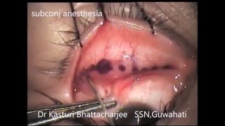 Lower Lid Blepharoplasty with Subperiosteal Transfer of Medial Fat Pad