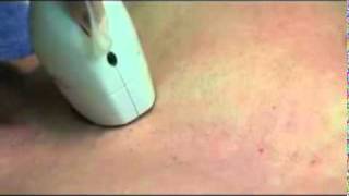 Laser Hair Removal Treatment, Ipl Hair Removal, Hollywood H