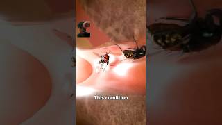 How flies lay maggots in your ear?