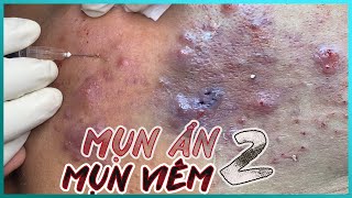 Big Cystic Acne Blackheads Extraction Blackheads & Milia, Whiteheads Removal Pimple Popping