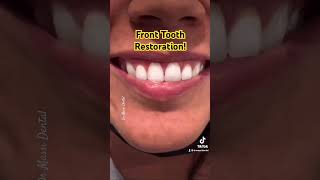 Front Tooth Restoration