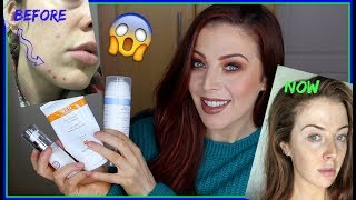 How I Got My Skin GOOD! ANNOUNCEMENT OF MY REN BRAND AMBASSADOR ROLE! [Laura's Views]