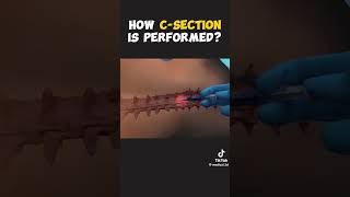 How c- section is performed ?