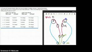 462 FA PUPILLARY LIGHT REFLEX