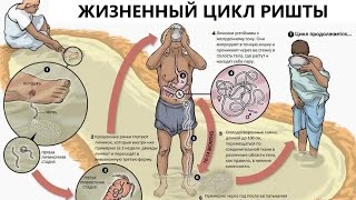 Дракункулез: жизненный цикл ришты