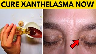 xanthelasma removal at home naturally - remove cholesterol deposits around eyelids