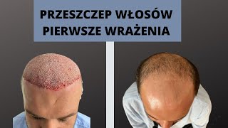 Przeszczep włosów w Turcji - pierwsze wrażenia.