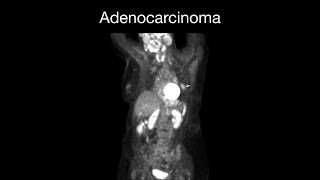 Adenosarcoma