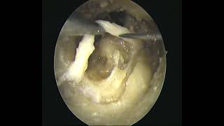 Temporal bone dissection part-1(2-hand endoscopic)Facial Nerve-dr.shreekantha acharya