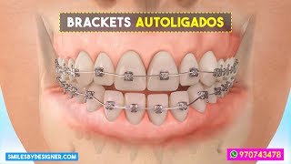 🔥 Brackets Autoligables o 💥 Sistema Damon en Lima Perú - Smiles by Designer