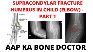 SUPRACONDYLAR FRACTURE HUMERUS IN A CHILD (ELBOW) - PART 1 -EPISODE 27