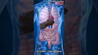 Cirrohisis- a serious liver desease