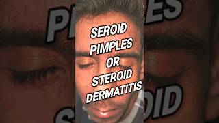 Steroid cream side effects on face @DrArifMDDermatologist #steroidacne #steroidssideeffects #short