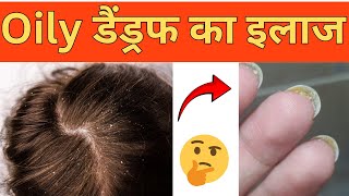 ऑयली डैंड्रफ कैसे हटाएं?  | how to remove dandruff ? #shampoo  #dandruff