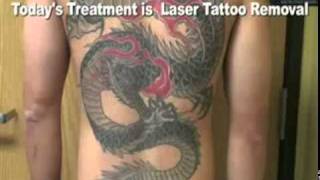 Tattoo Removal, Remove Tattoo, Burbank, (877) 650-7267