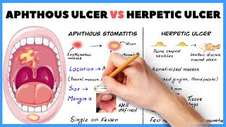 Aphthous ulcer (Aphthous stomatitis) vs Herpetic ulcer : How to diagnose