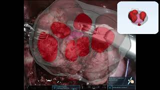 3D print model for precise pre surgical planning in Robotic Myomectomy