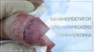 😧 Баланопостит от гемолитического стафилококка. Клинический случай №49