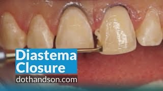 Resin Veneer and Diastema Closure by Dr. Dennis Hartlieb