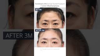 [B&A] Forehead Lift, Lower Blepharoplasty at V.LIF Plastic Surgery Clinic in Korea #shorts