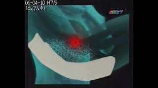 04.06.2010 | HTV9 - TVC Salonsip Gel-Patch