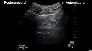 An ultrasound-guided lateral approach to proximal sciatic nerve block: Pitfalls and tips