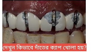 দেখুন কিভাবে দাঁতের ক্যাপ খোলা হয়? দাঁতের ক্যাপ খোলার উপায়। Tech Dental