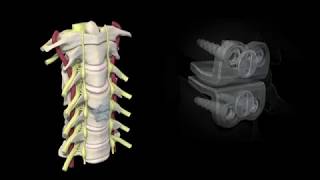 Artificial Cervical Disc