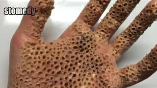 EXTREME Trypophobia Hand!! Trypophobia Disease Is Real Or Fake | December 2017_ 18