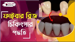 ফাইবার ব্রিজ চিকিৎসার পদ্ধতি ।। Fiber Bridge Treatment Procedure II Tech Dental