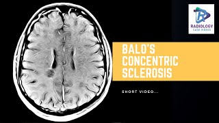 Balos concentric sclerosis  #Umamaheshwar Reddy. V