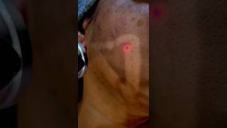 pigmentation Treatment with Carbon laser.#skincare #pigmentation #viralshort #yt