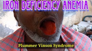 Iron deficiency anemia | koilonychia | Plummer Vinson Syndrome |#irondeficiency #nails