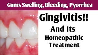 Homeopathic Medicine For Gingivitis | Poyorrhea | Gum Swelling | مسوڑھوں کی سوجن اور خون کا آنا